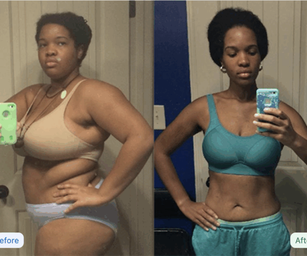 Thinnex-before-and-after-girl-in-turqoise